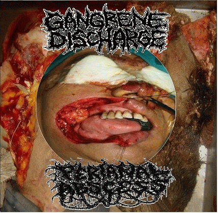 Gangrene Discharge : Gangrene Discharge - Perianal Abscess
